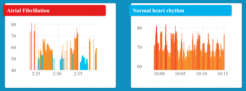 Graph showing atrial fibrillation from normal heart rhythm